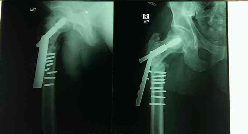 Left Hip Fracture Icd 9 Therapy Fracture