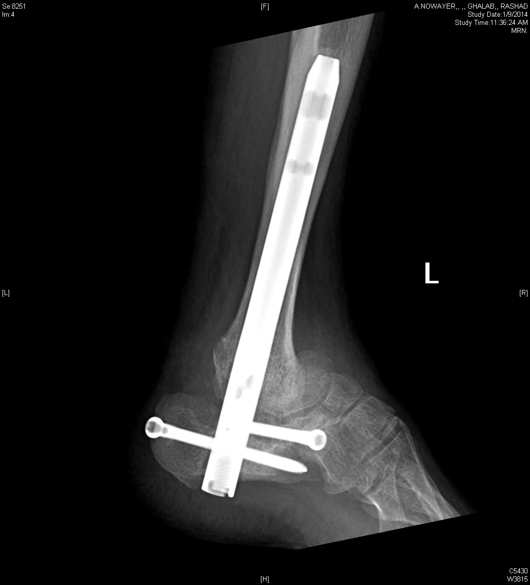 Diabetic Charcot Neuropathy Foot & Ankle Orthobullets