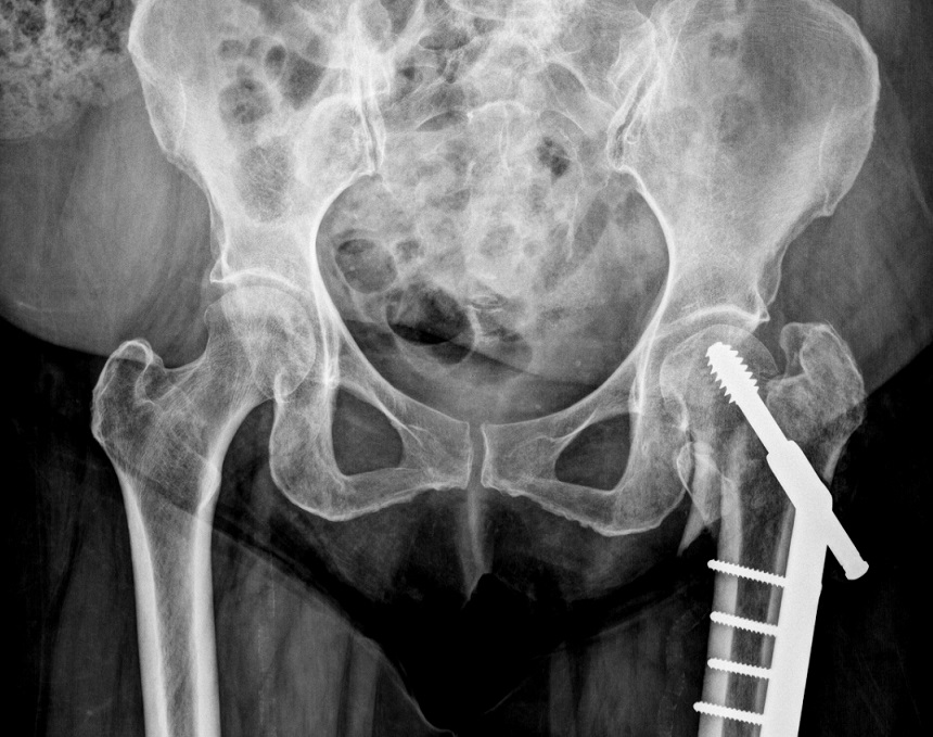 Intertrochanteric Fractures Trauma Orthobullets