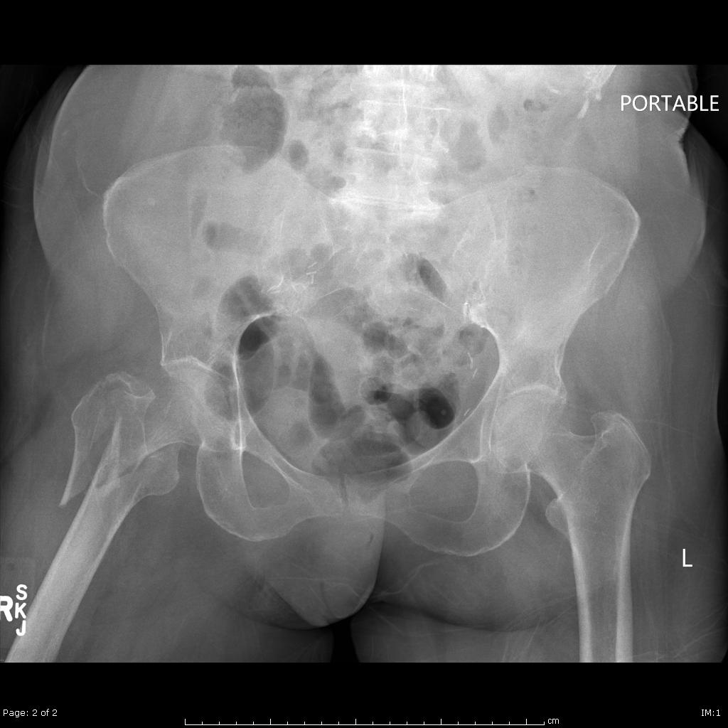 Reverse Obliquity Intertrochanteric Fracture Recovery FRACTURE