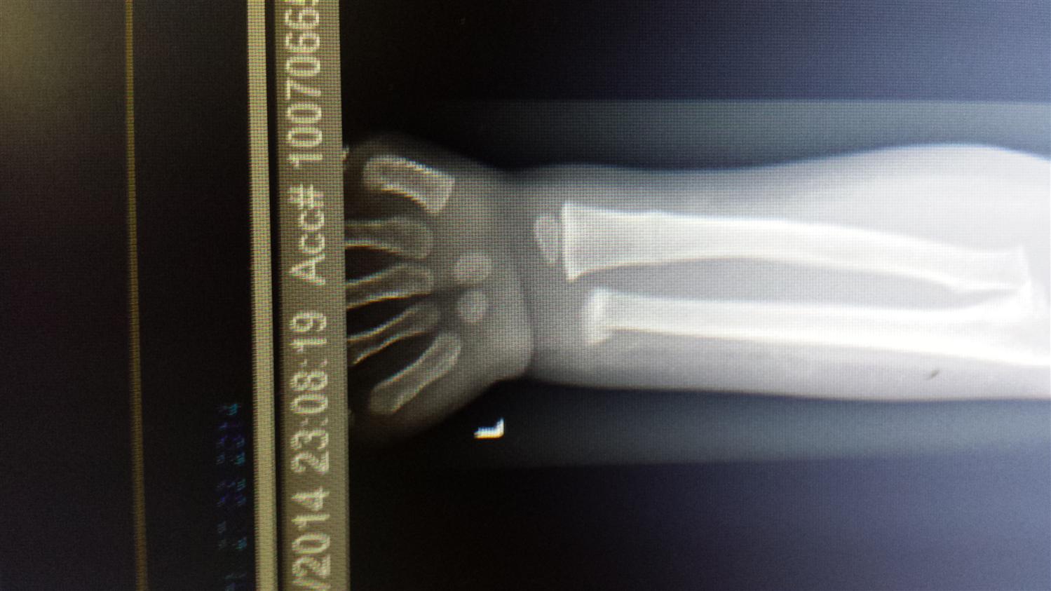 Distal Radius Fractures Pediatric Pediatrics Orthobullets