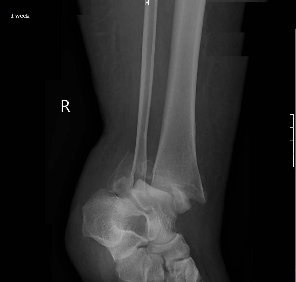 Ankle Fractures Trauma