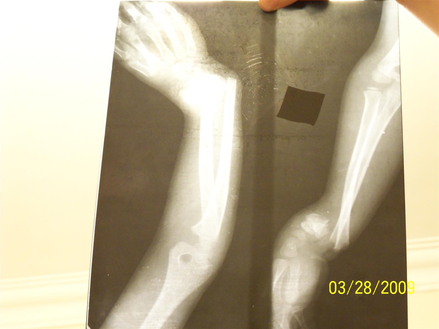 Pediatric Distal Radius Fracture