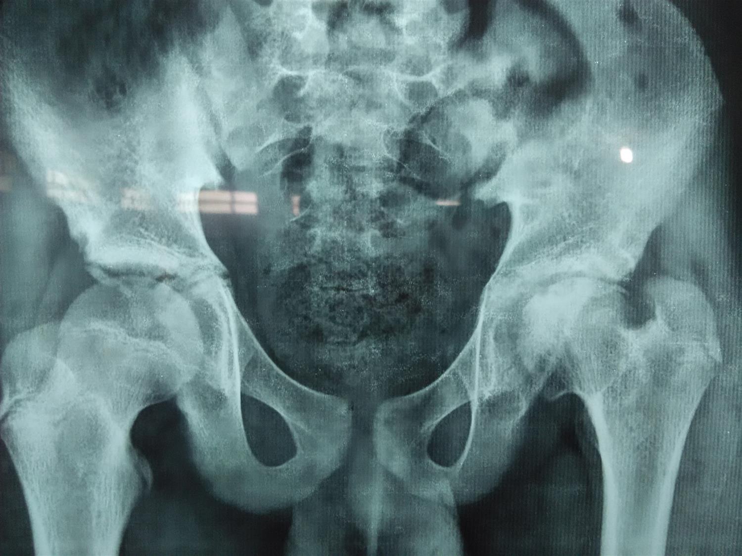 LeggCalvePerthes Disease (Coxa plana) Pediatrics Orthobullets