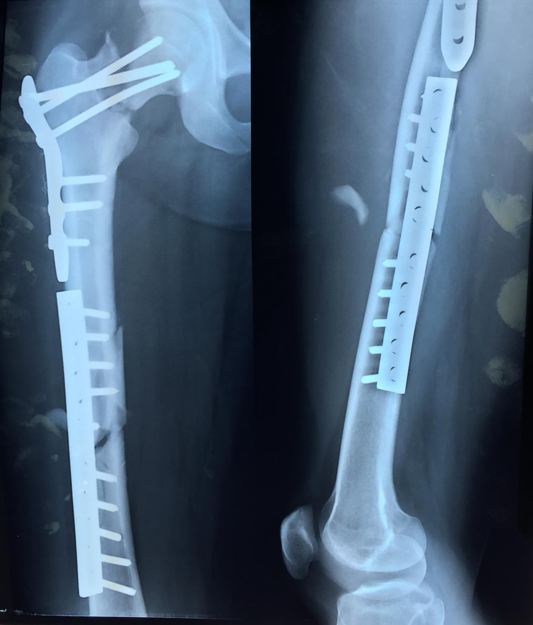 Femoral Neck Fractures Trauma Orthobullets