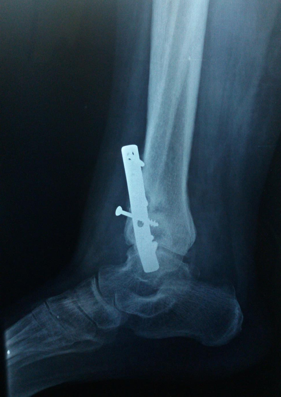 Ankle Fractures Trauma