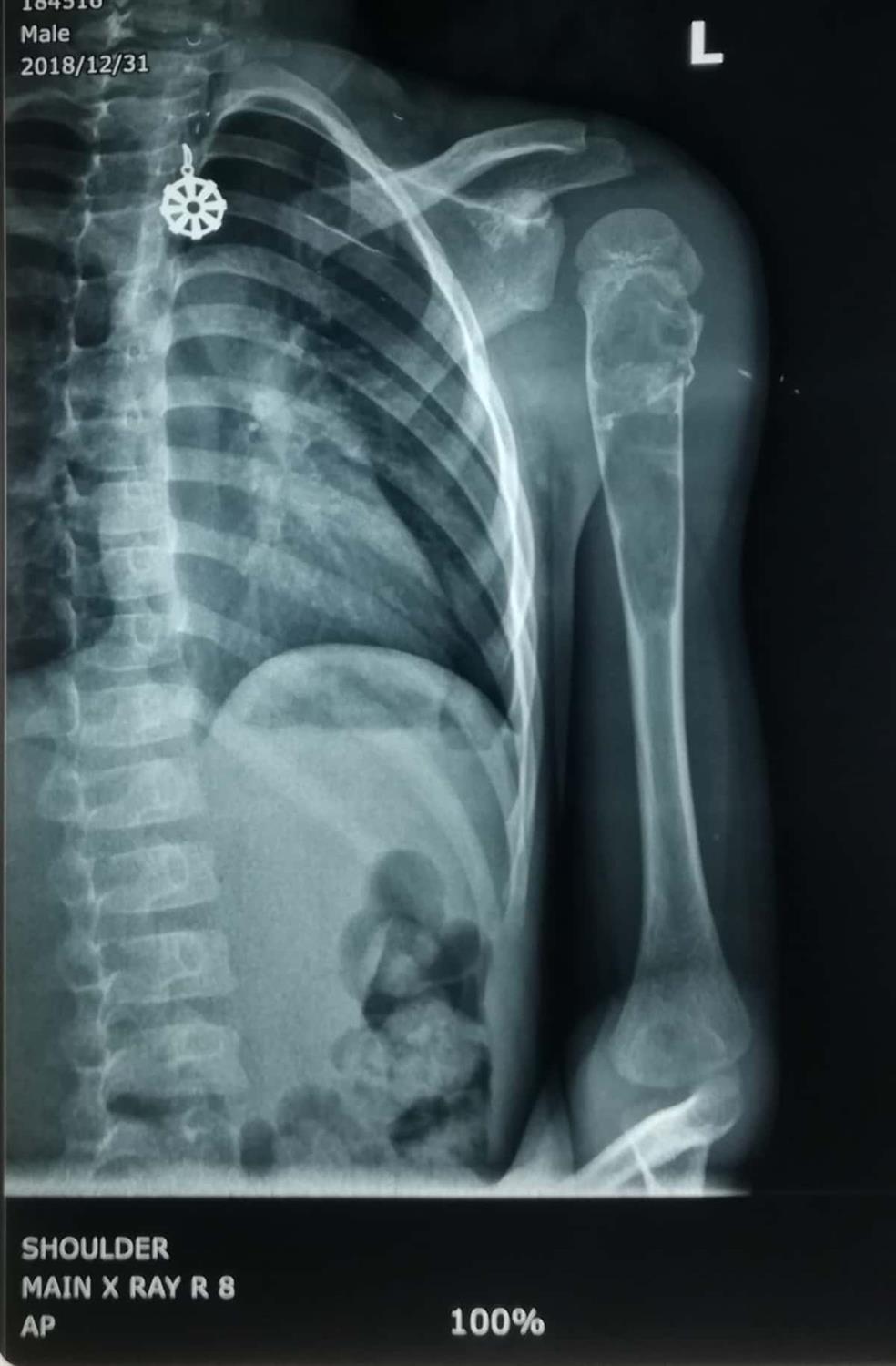 Aneurysmal Bone Cyst Pathology Orthobullets
