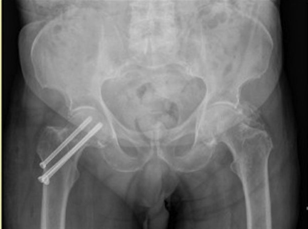 Femoral Neck Fractures Trauma Orthobullets