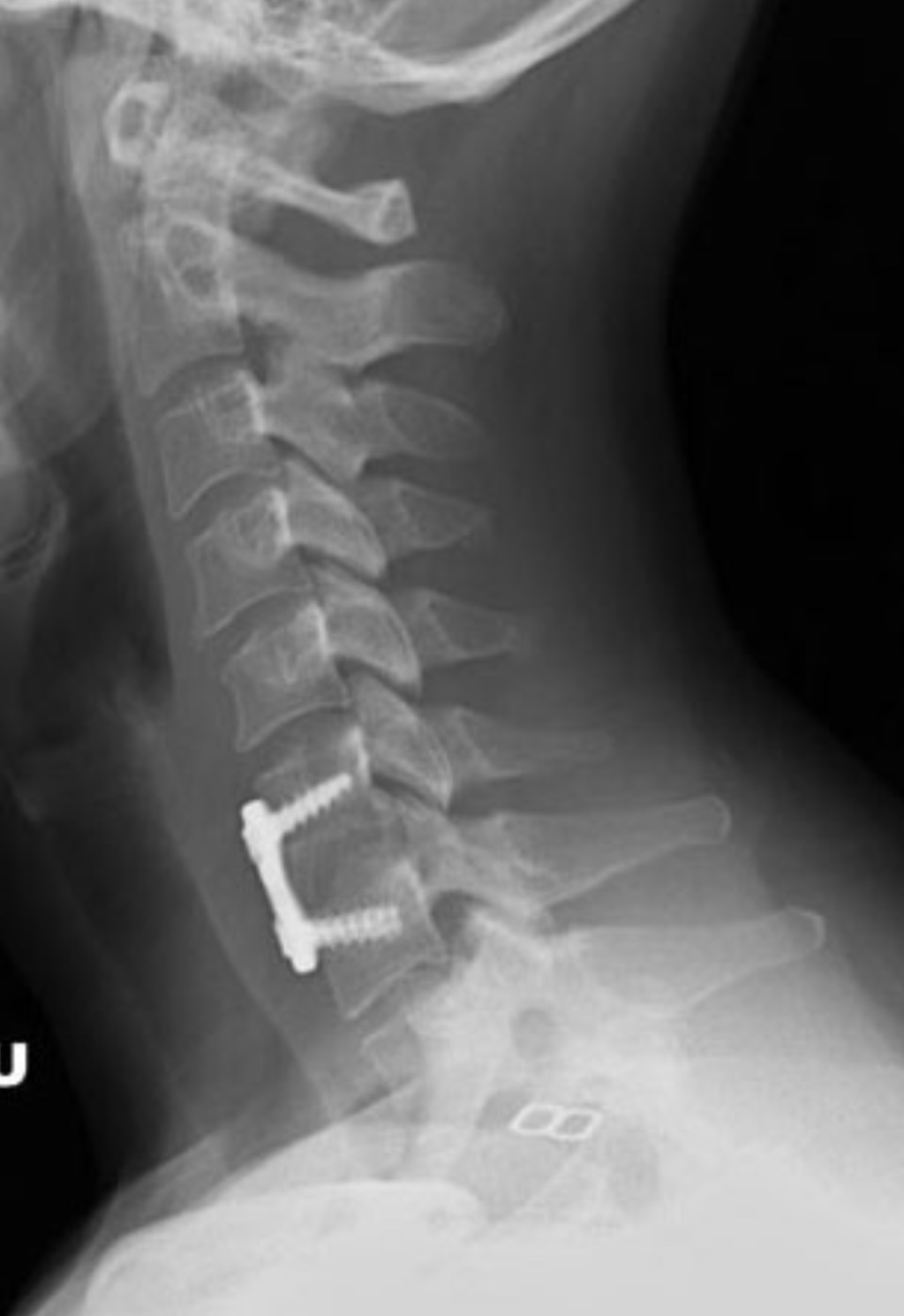 Cervical Radiculopathy Spine Orthobullets