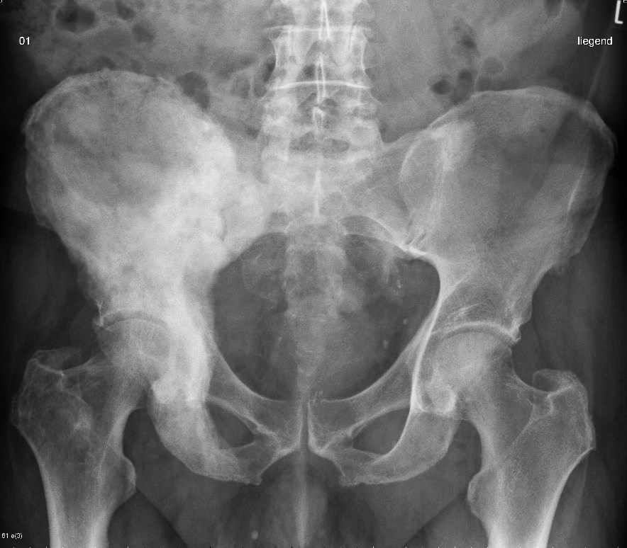 Paget's Disease Pathology Orthobullets