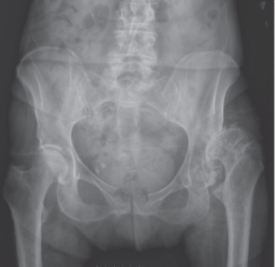 Adult Dysplasia of the Hip Recon Orthobullets