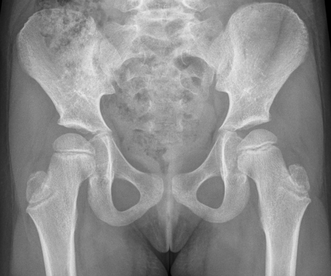 Hip Septic Arthritis Pediatric Pediatrics Orthobullets