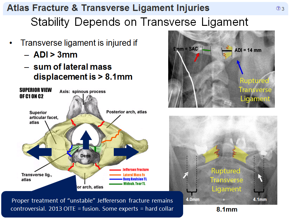 Atlas Fractures & Transverse Ligament Injuries Spine Orthobullets