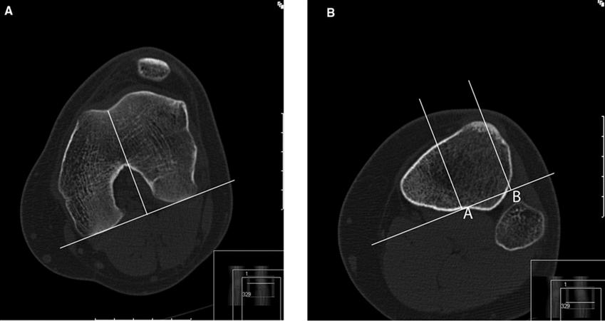 Lateral Patellar Compression Syndrome - Knee & Sports - Orthobullets