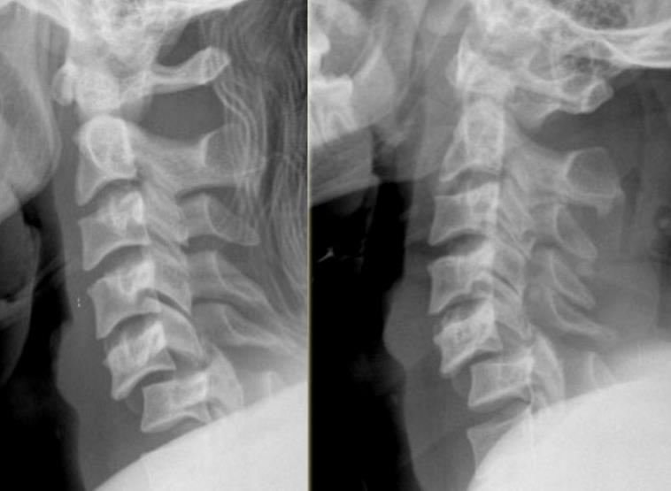 Cervical Facet Dislocations & Fractures Spine Orthobullets