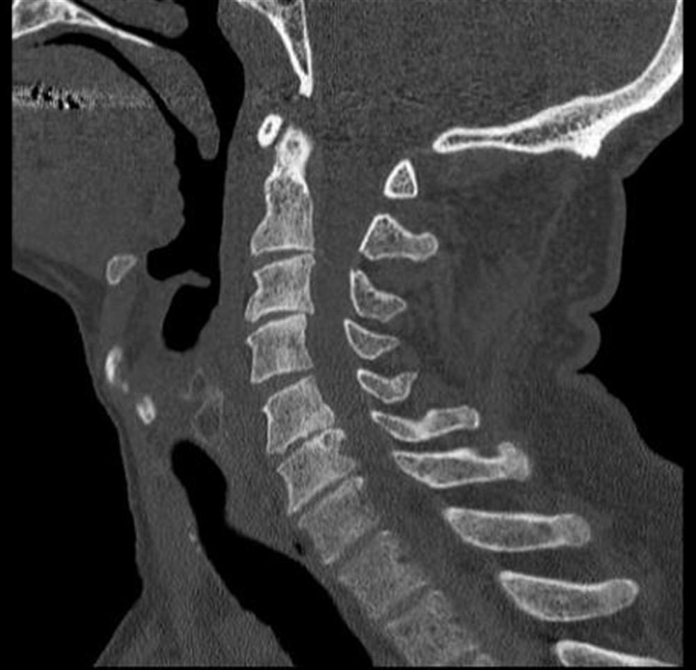 Spinal Cord Injuries Spine Orthobullets