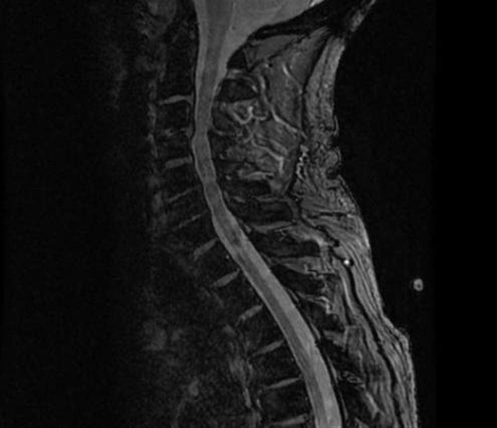 Spinal Cord Injuries Spine Orthobullets