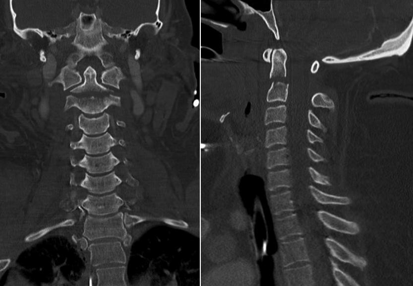 Odontoid Fracture X Ray