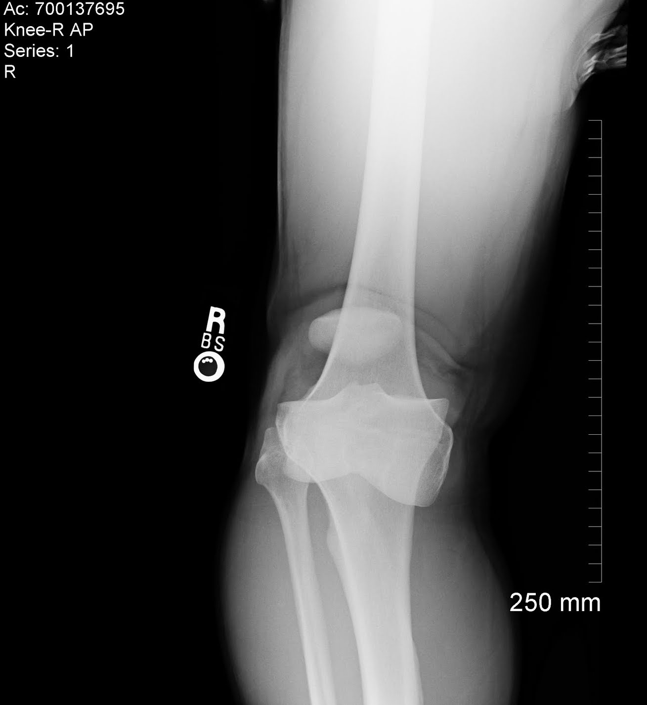 Knee Dislocation Trauma Orthobullets