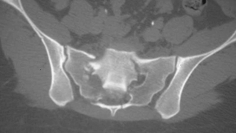 Sacral Fractures - Trauma - Orthobullets