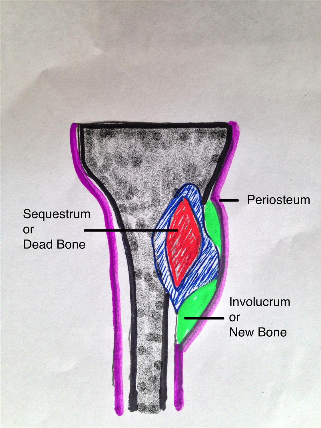 Osteomyelitis Pediatric Pediatrics Orthobullets