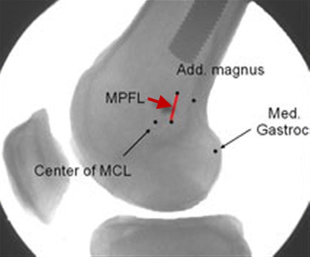 Patellar Instability Knee & Sports Orthobullets