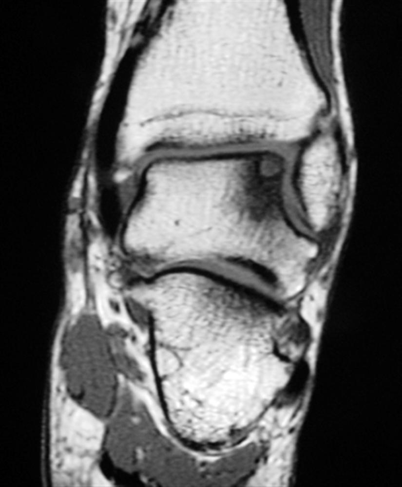 Osteochondral Lesions of the Talus Foot & Ankle Orthobullets