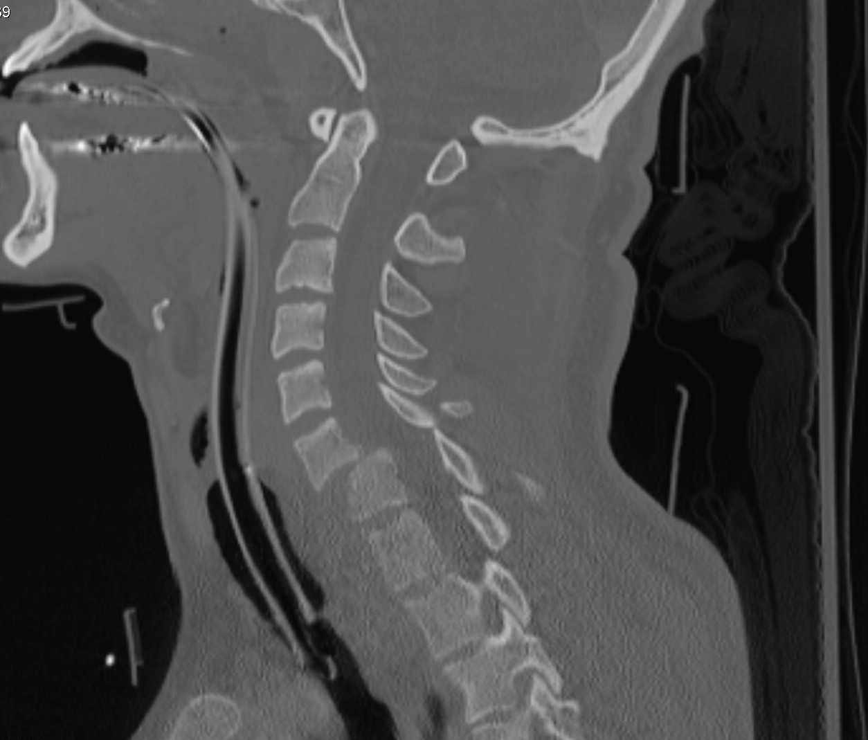 Cervical Radiculopathy Spine Orthobullets