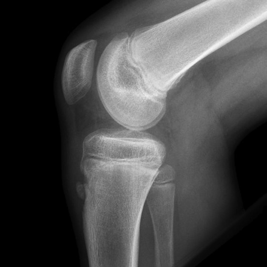 Osgood Schlatter's Disease (Tibial Tubercle Apophysitis) Knee