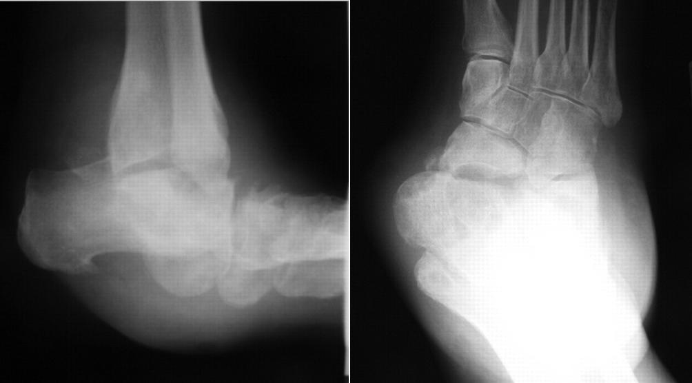 Diabetic Charcot Neuropathy Foot & Ankle Orthobullets