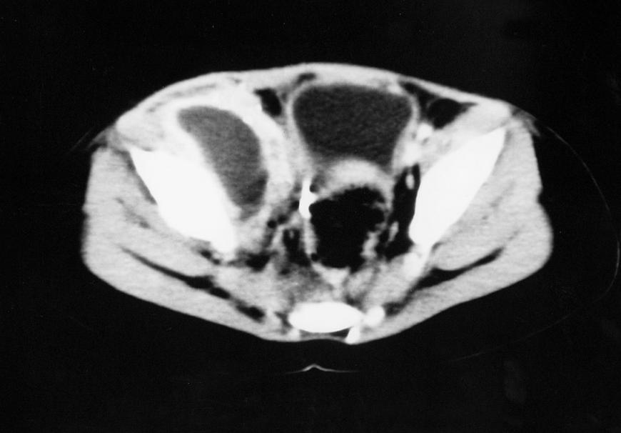 Hip Septic Arthritis Pediatric Pediatrics