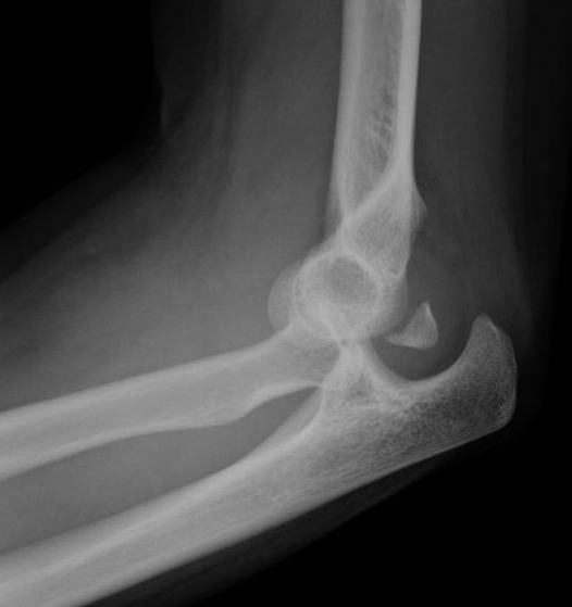 Elbow Flexion Contracture