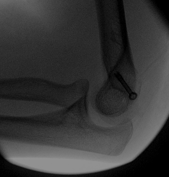 Elbow Stiffness and Contractures Shoulder & Elbow Orthobullets