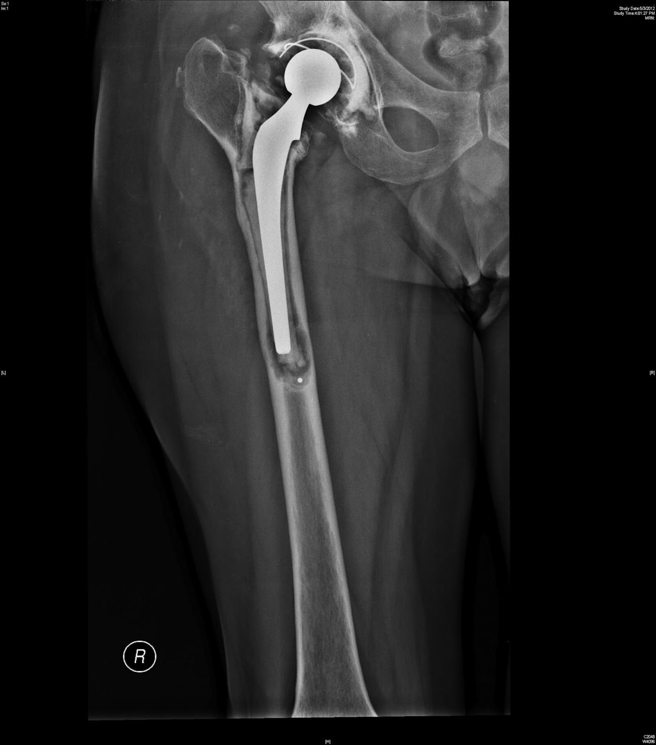 THA Aseptic Loosening Recon Orthobullets