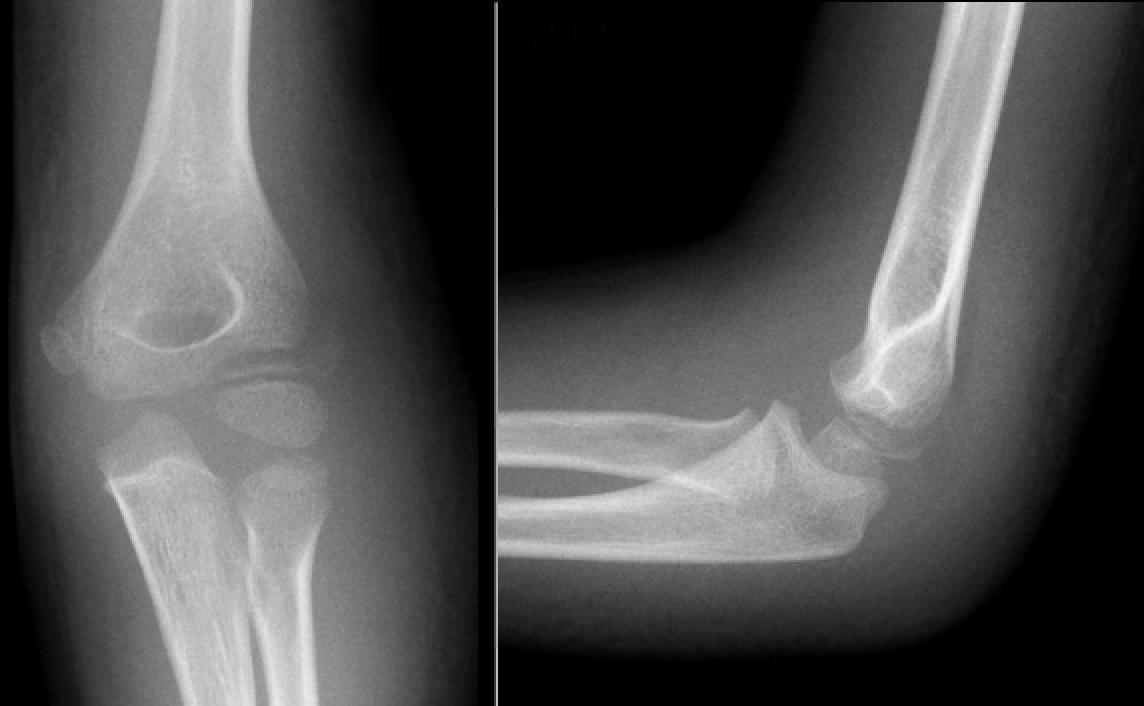 Supracondylar Fracture Pediatric Pediatrics Orthobullets
