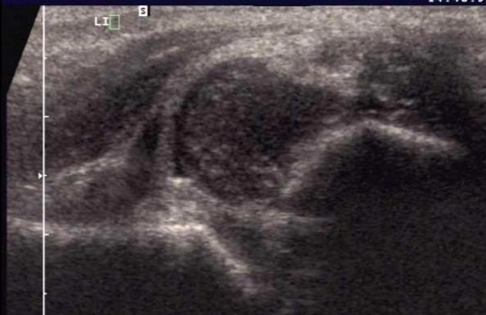 Developmental Dysplasia of the Hip (DDH) Pediatrics Orthobullets