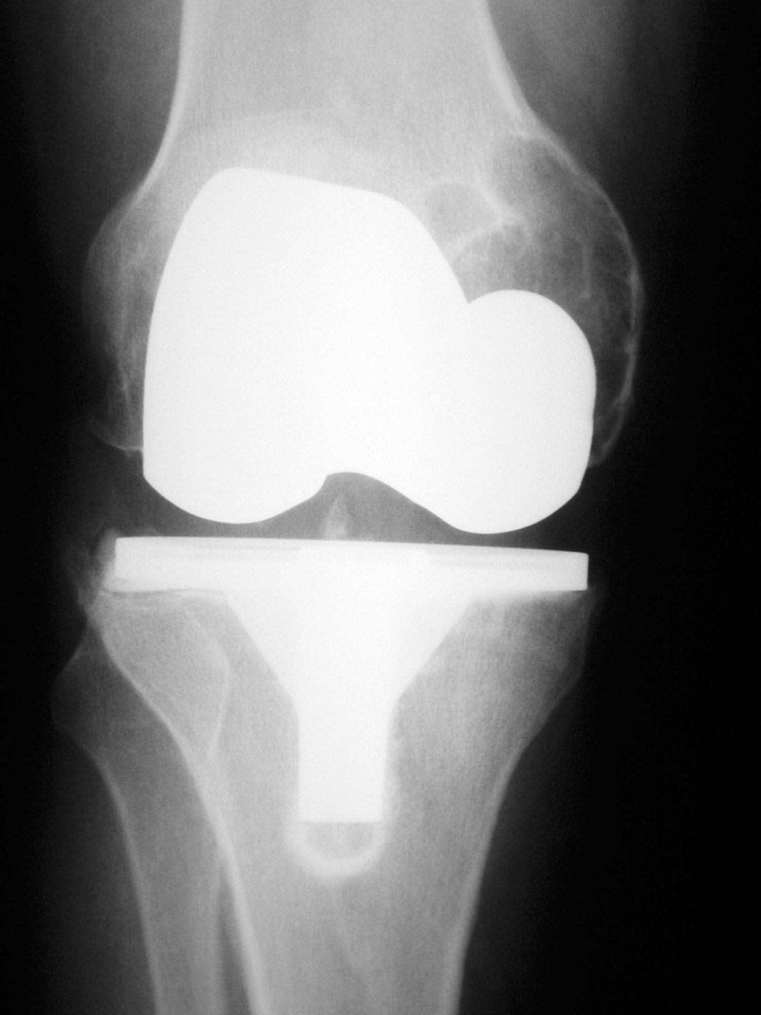 TKA Aseptic Loosening Recon Orthobullets
