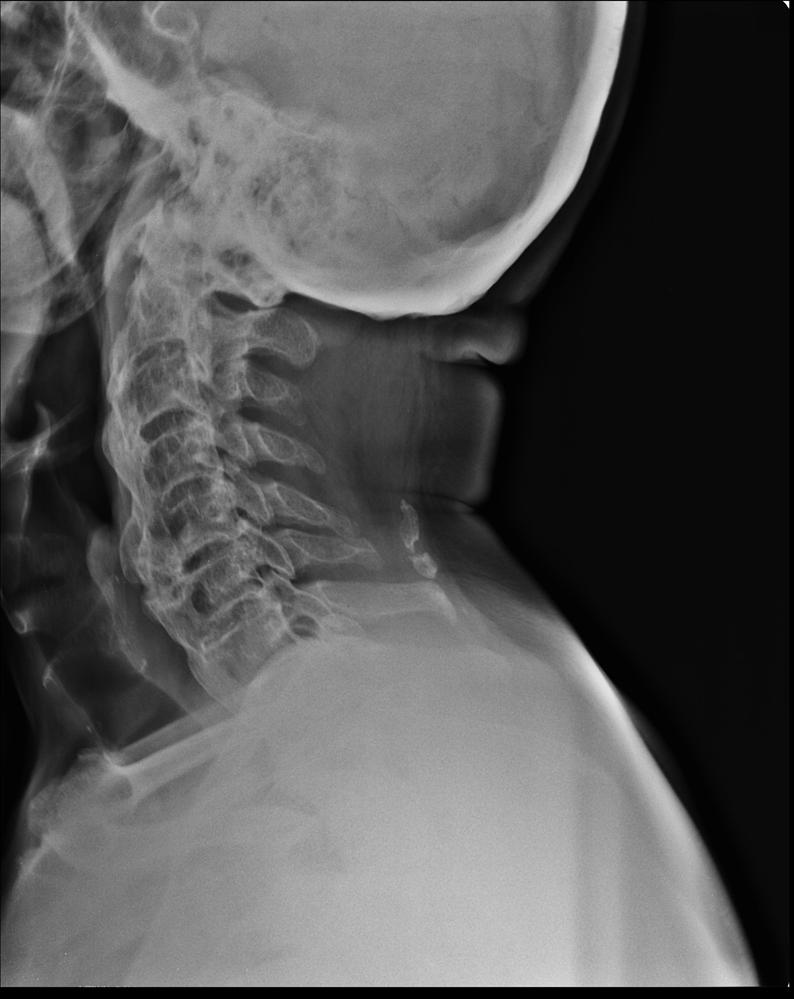 DISH (Diffuse Idiopathic Skeletal Hyperostosis) Spine Orthobullets