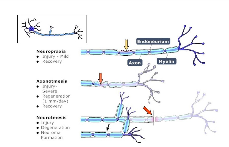 Peripheral Nerves Injury & Repair Hand Orthobullets