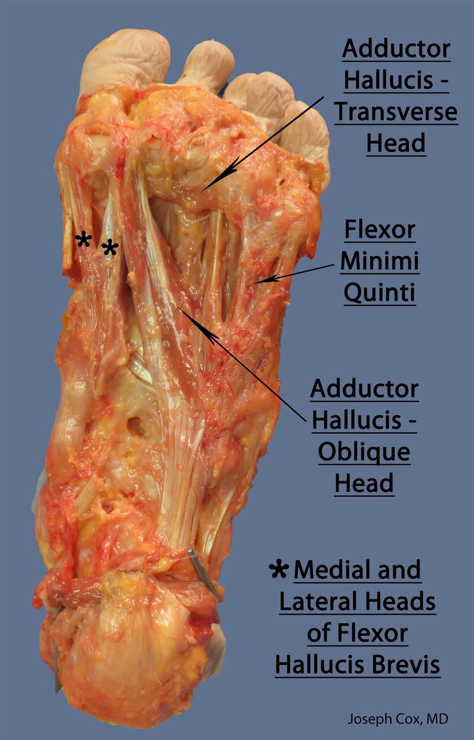 Flexor hallucis brevis (MPN) Anatomy Orthobullets