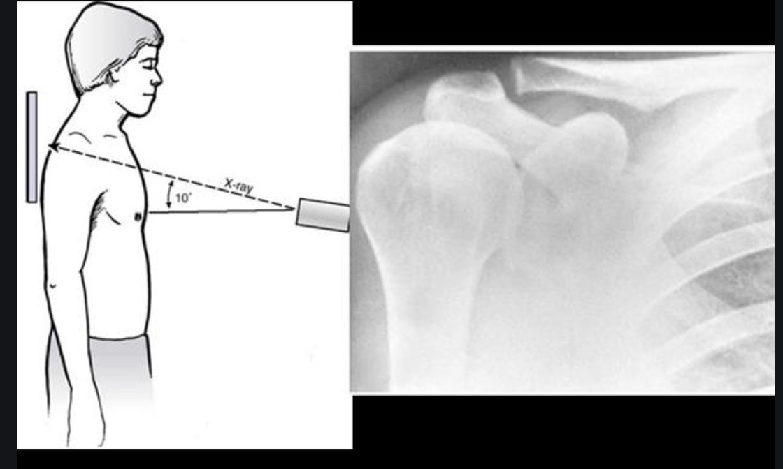 Clavicle Fractures Midshaft Trauma Orthobullets