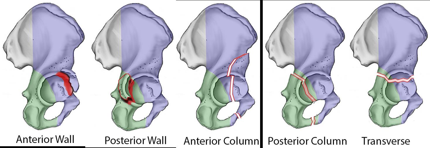 Acetabular Fractures Trauma Orthobullets