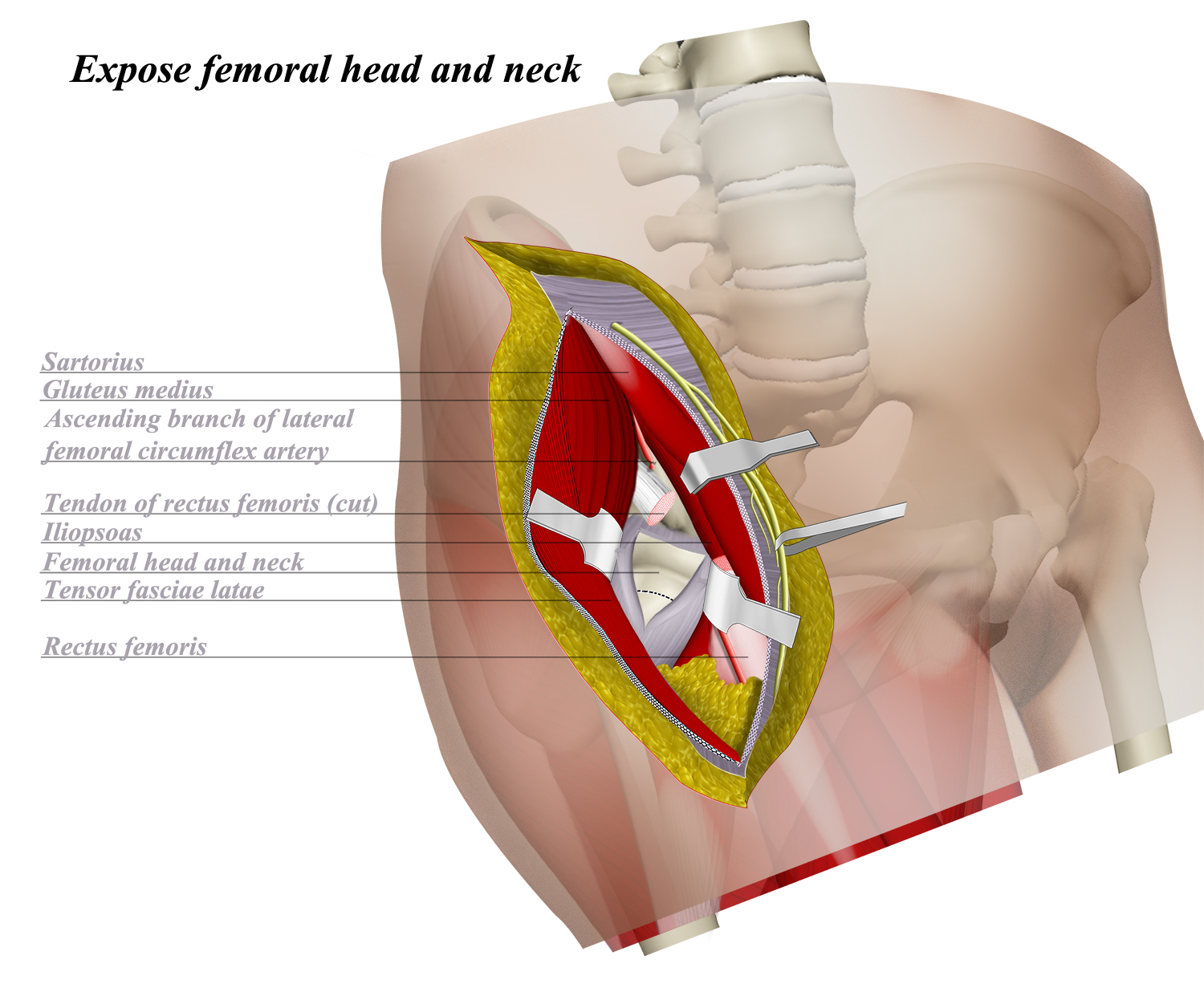 Hip Anterior Approach (SmithPetersen) Approaches Orthobullets