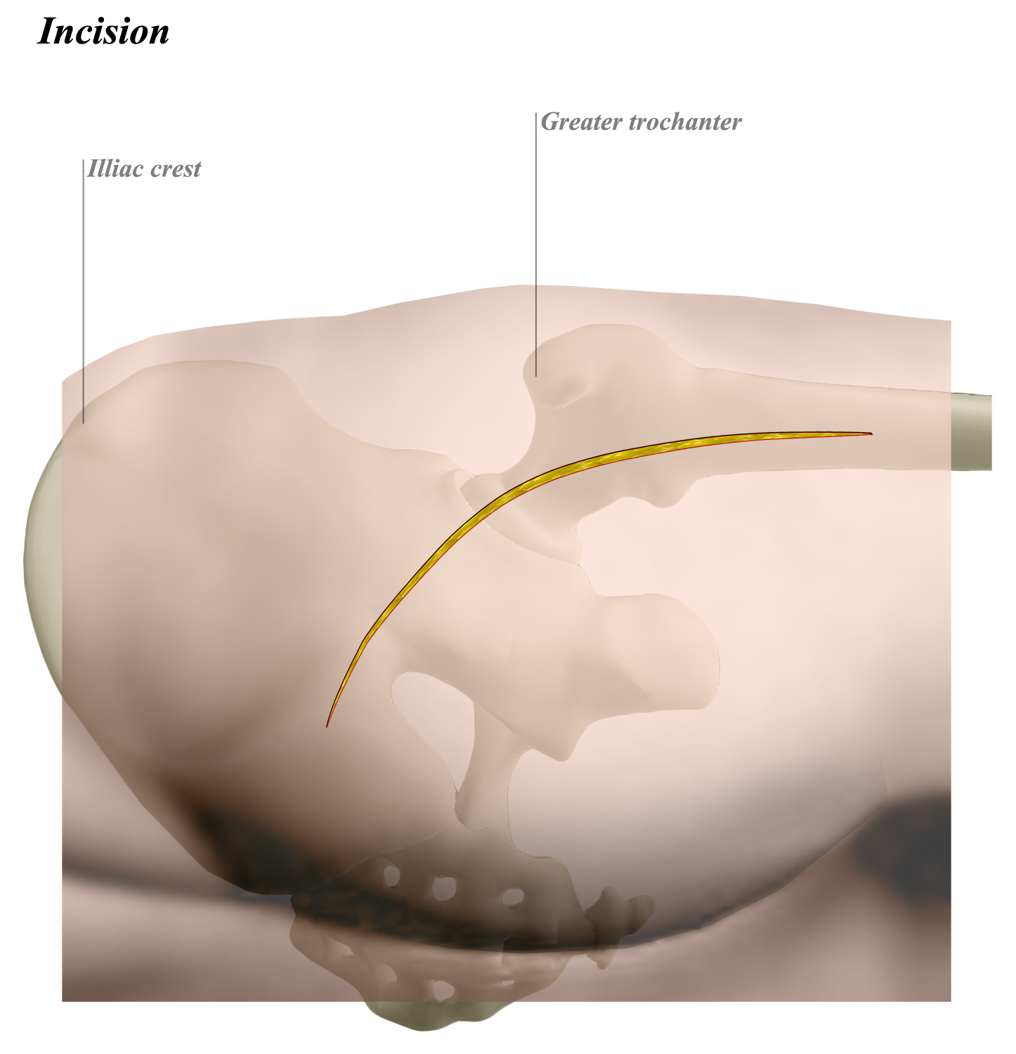 Hip Posterior Approach (Moore or Southern) Approaches Orthobullets