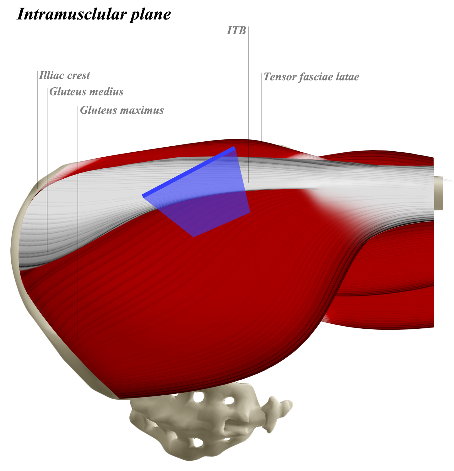 Hip Posterior Approach (Moore or Southern) Approaches Orthobullets
