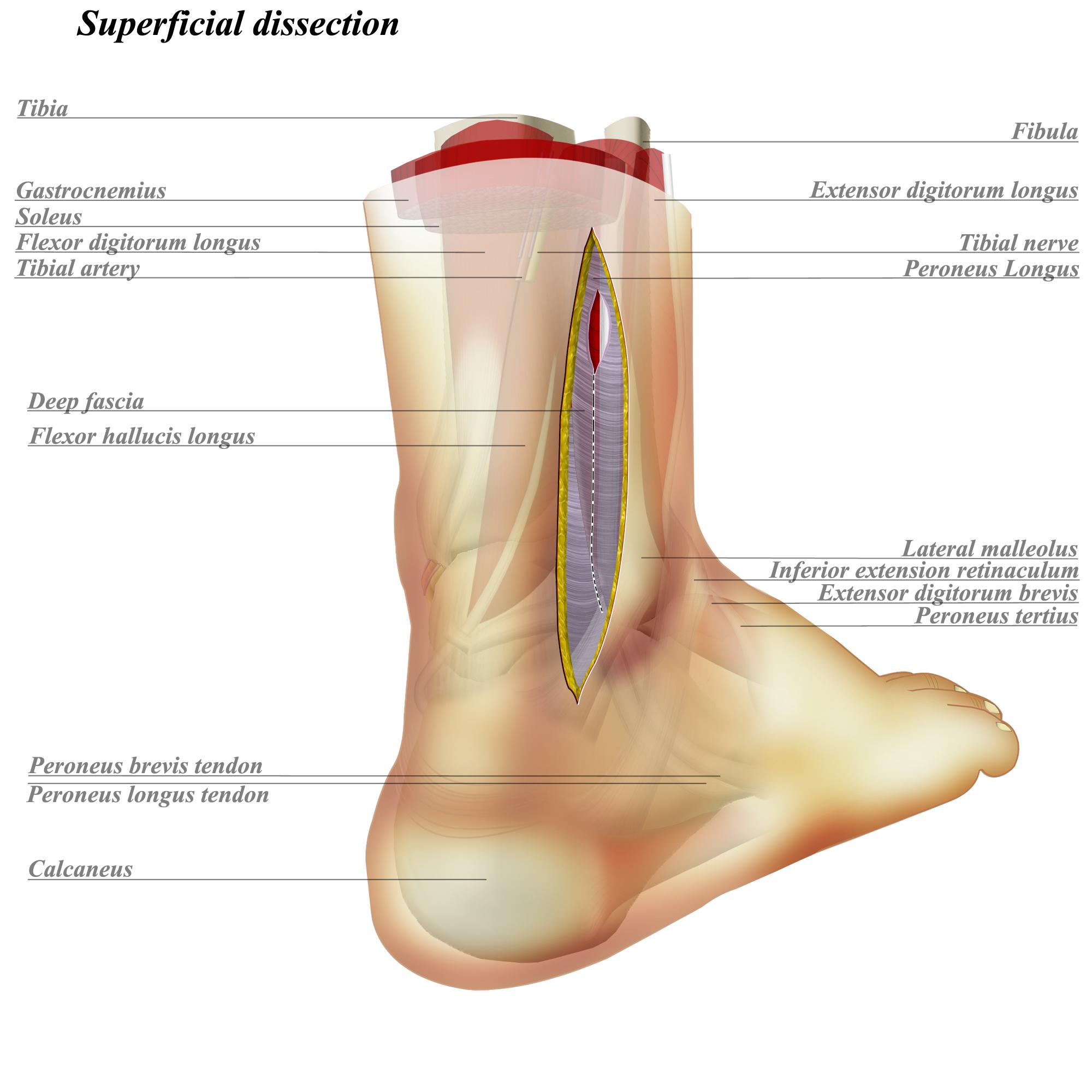 Ankle Posterolateral Approach Approaches Orthobullets