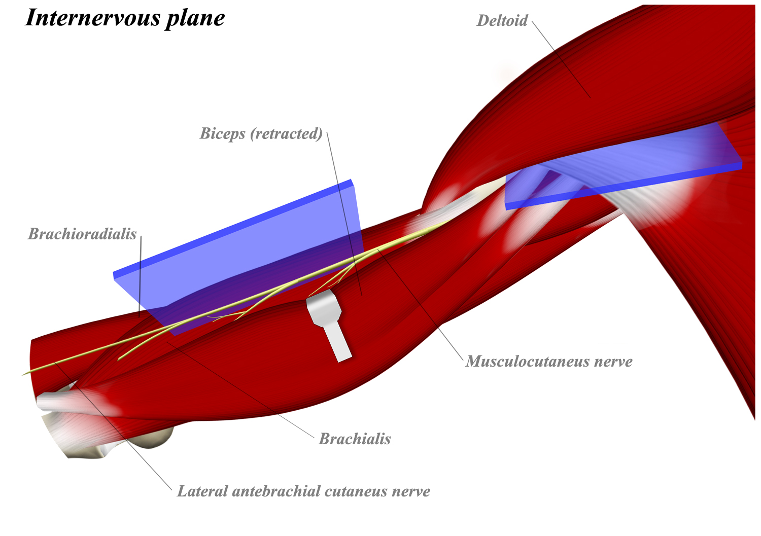 Anterior (Brachialis Splitting) Approach to Humerus Approaches