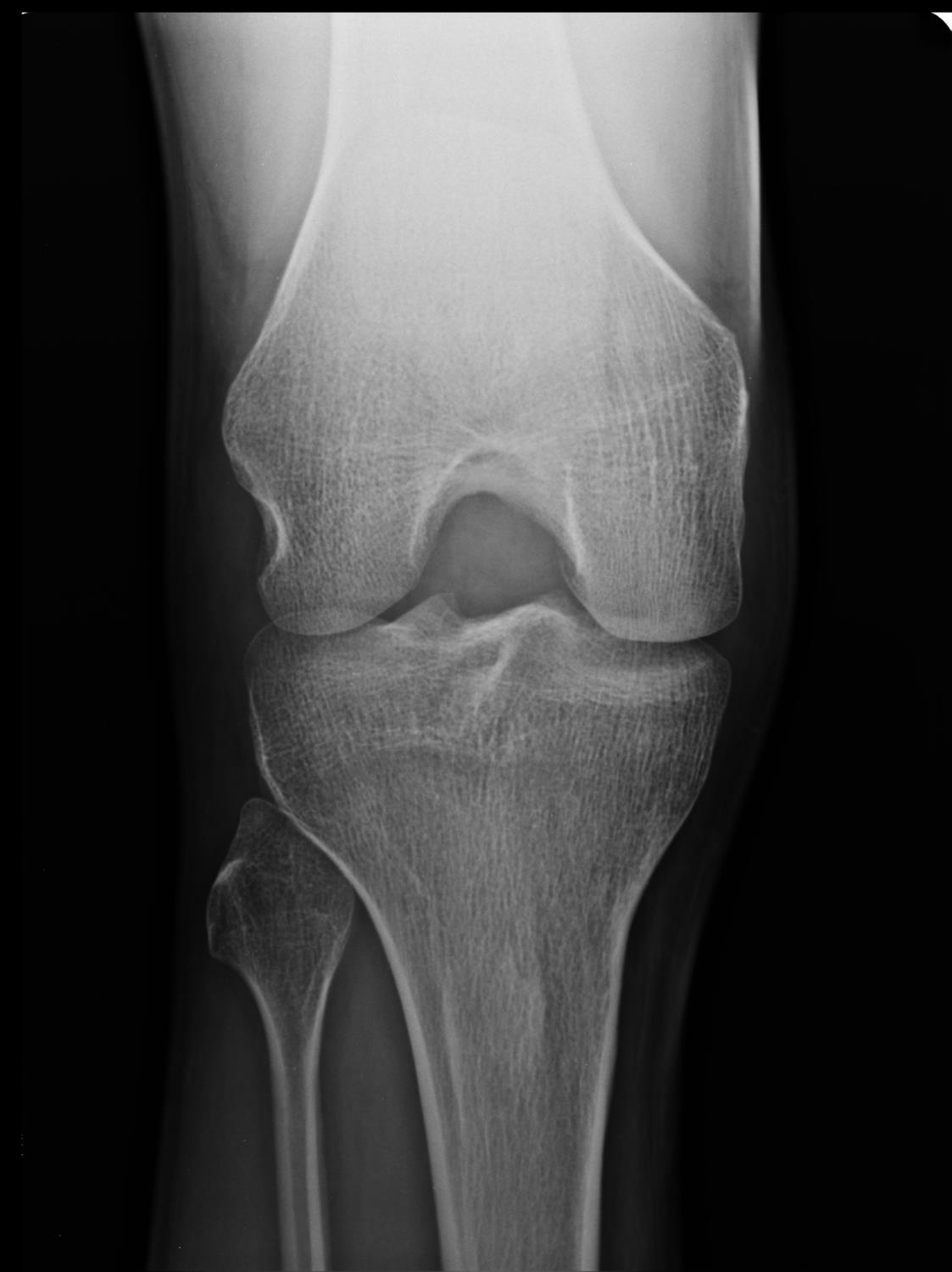 Knee Osteoarthritis Recon Orthobullets