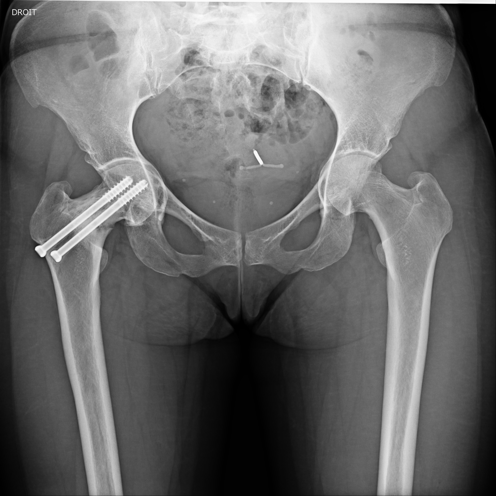 Femoral Neck Fracture Nonunion Trauma Orthobullets