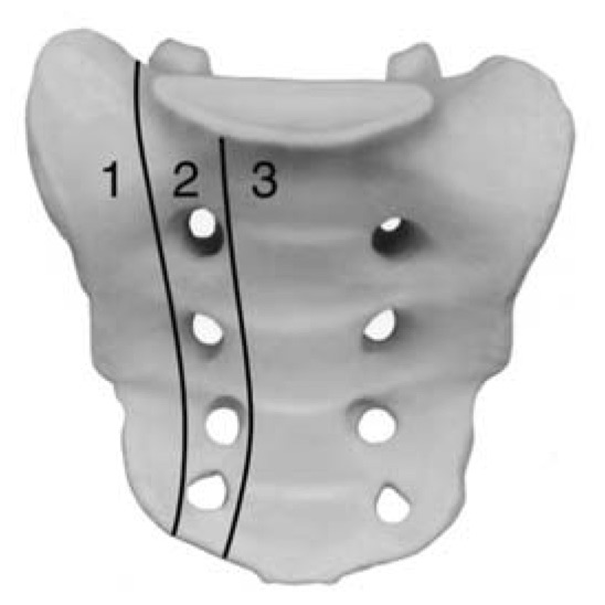 Sacral Insufficiency Fracture Spine Orthobullets